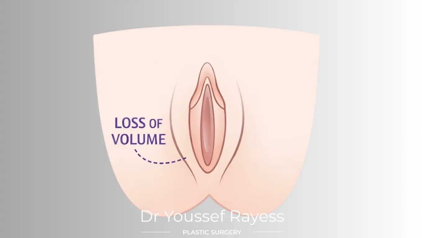 Front view before intimate area fat grafting surgery result by Dr Youssef Rayess in Beirut showing natural intimate area rejuvenation and harmony